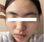 女性、17歳、ニキビ治療、AFTER