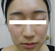 女性、19歳、ニキビ治療、BEFORE