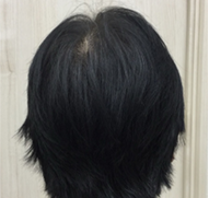女性、68歳、発毛治療、AFTER