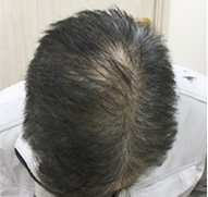 男性、58歳、発毛治療、AFTER