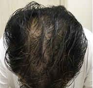 男性、48歳、発毛治療、AFTER