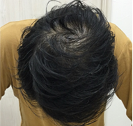 男性、34歳、発毛治療、AFTER