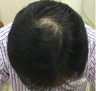 男性、57歳、発毛治療、AFTER