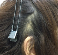 女性、55歳、発毛治療、AFTER