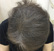 女性、61歳、発毛治療、AFTER