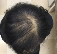 女性、63歳、発毛治療、AFTER