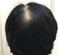 女性、68歳、発毛治療、BEFORE