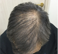 男性、58歳、発毛治療、BEFORE