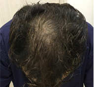 男性、48歳、発毛治療、BEFORE