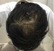男性、34歳、発毛治療、BEFORE