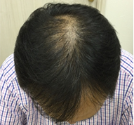 男性、57歳、発毛治療、BEFORE