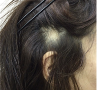 女性、55歳、発毛治療、BEFORE