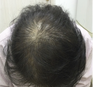 女性、61歳、発毛治療、BEFORE