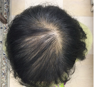 女性、63歳、発毛治療、BEFORE