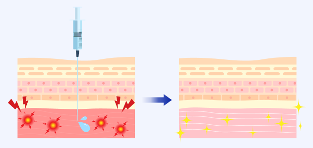 筋肉再生注射(つぼ注)イラスト